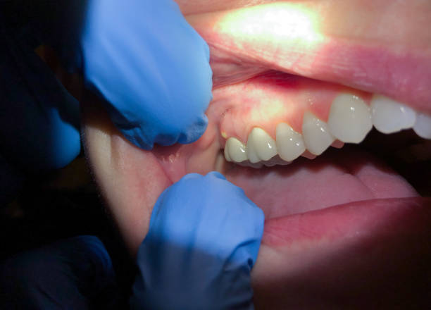 Best Emergency Dental Care for Abscessed Tooth in Montpelier, ID